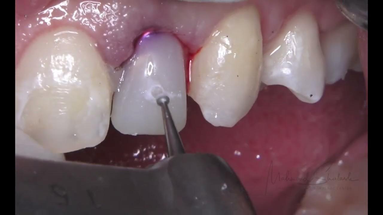 Immediate implant placement with chairside provisional crown youtube