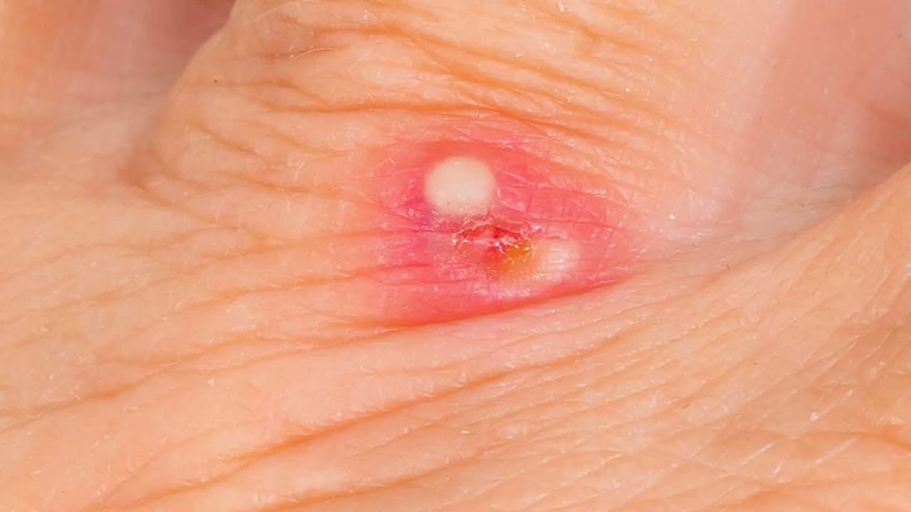 Amazing Popping huge blackheads and BEST Pimple Popping NEW Pimple