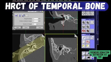 HRCT Temporal Bone/EAR/Mastoid/IAC Technique | Patient positioning-Reconstruction-Filming Process |