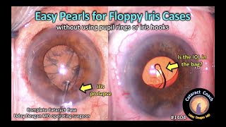 CataractCoach 1404: easy pearls for floppy iris cataract surgery