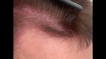 Scalp Micropigmentation For Thinning Hair | The Scalp Clinic Canterbury