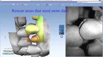 E4D video 6 Buccal scan