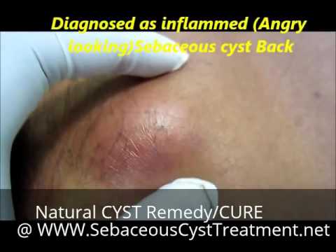 CYST REMEDY Natural CURE