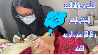 جلسه  ميكروبجمنتيشين مع العميله لاخفاء علامات التمدد واثار عمليات الجراحيه الغامقه ?