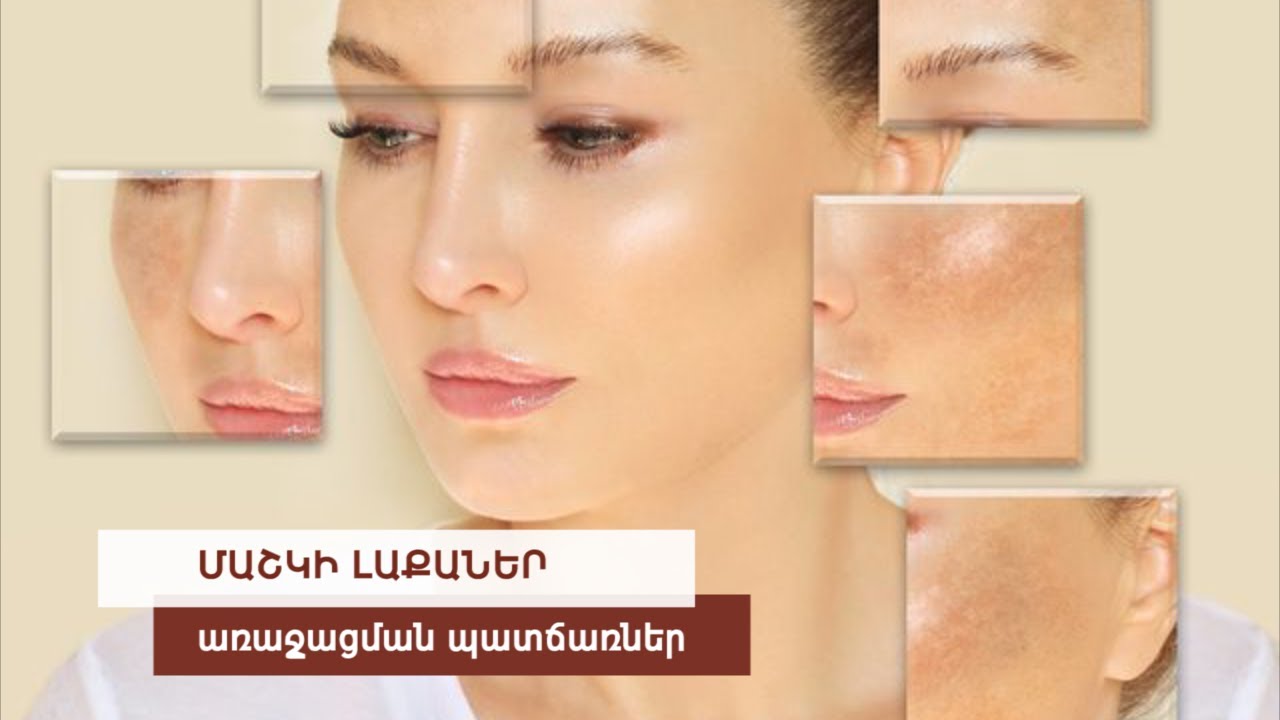 Մաշկի Մուգ Լաքաների Առաջացման Պատճառներ | Էնդոկրինոլոգի Խորհուրդներ | Մաշկիդ Դուր Կգա