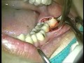 Removal of an impacted wisdom toothmesioangular impaction 1