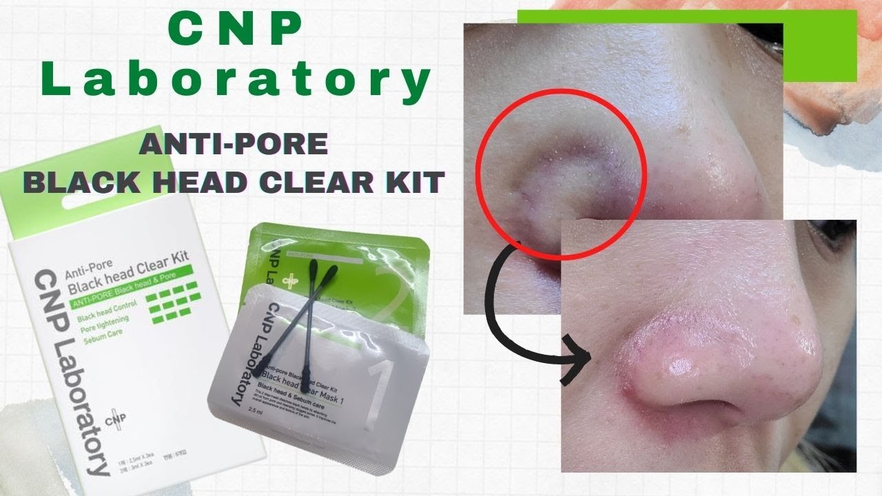 New Way to Remove White/Black Heads | CNP Laboratory Anti-Pore Black Head  Clear Kit |韓国IU代言希思派去黑头鼻貼膜- YouTube