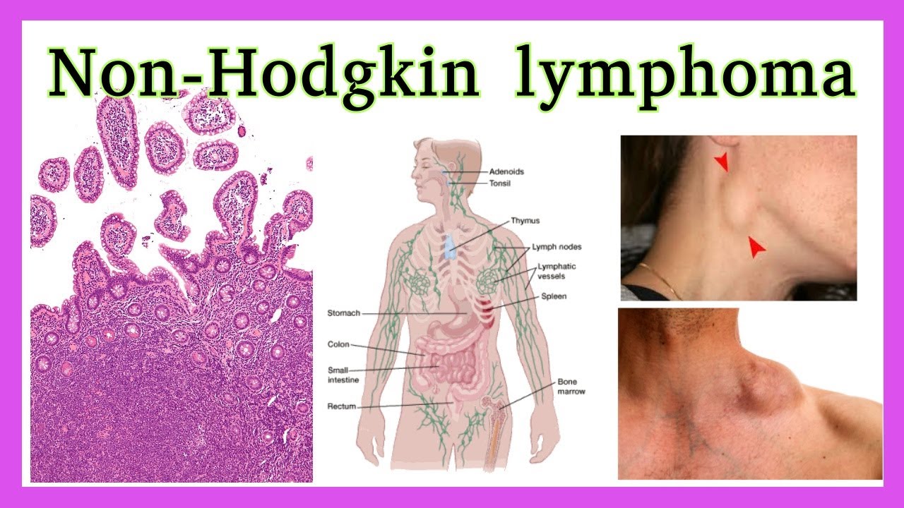 non Hodgkin lymphoma YouTube
