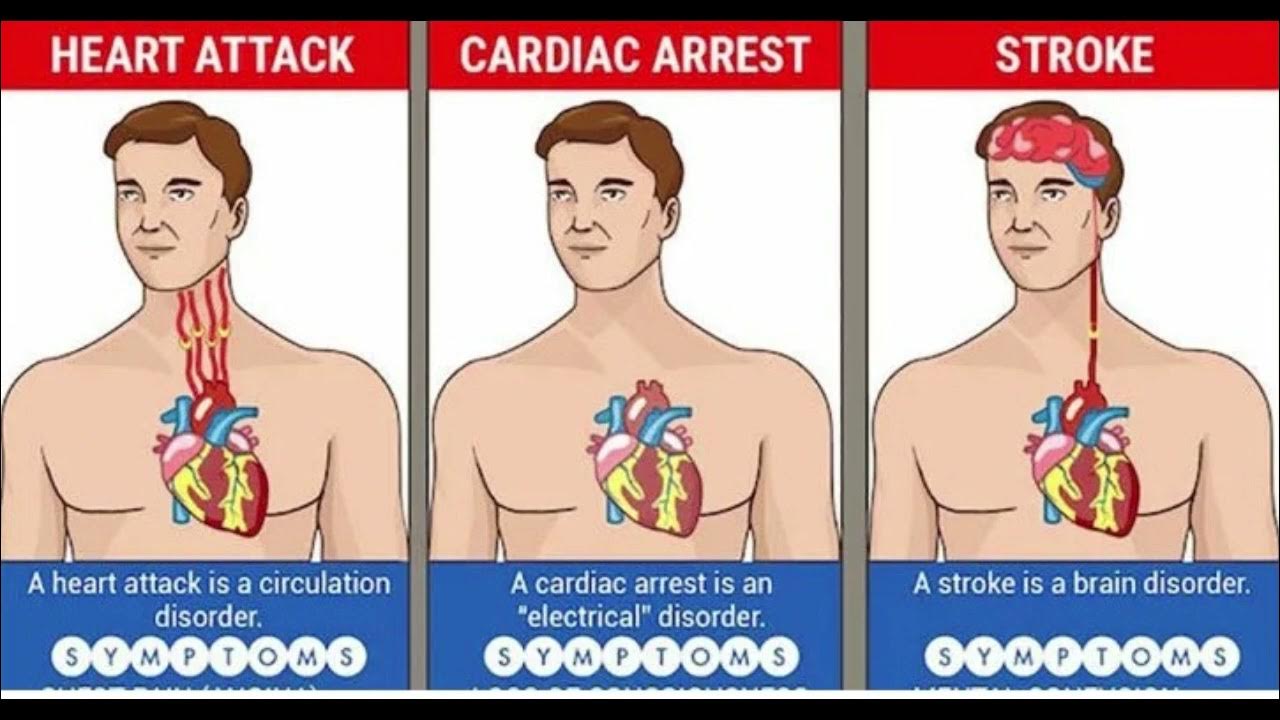 Как отличить сердечный. Инсульт и остановка сердца. Остановка сердца инфаркт.