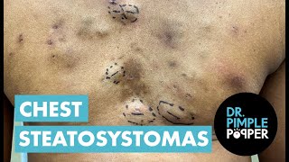 Steatocystomas and a Surprise!