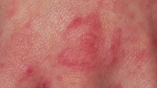 DO YOU HAVE SCABIES? CLOSE LOOK AT THE SCABIES RASH