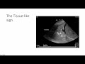 Lung Ultrasound: Alveolar Consolidation - Shred Sign
