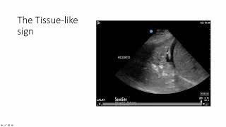 Lung Ultrasound: Alveolar Consolidation - Shred Sign