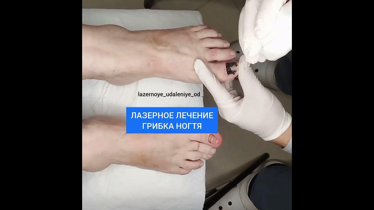 Лазерное лечение грибка ногтя - YouTube