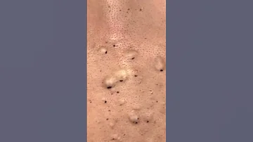 A Belly Full Of Steatocystomas Preview Shorts Drpimplepopper 