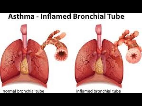 Asthma, causes, risk factors, clinical presentation, and treatment(pharmacology) ||Dr Najid