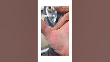 Pulled a Toothpick Out of a Man