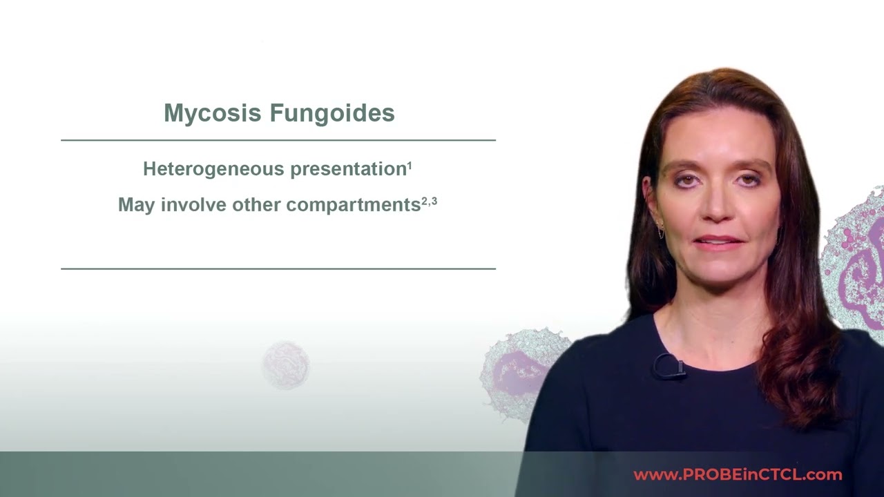 About CTCL Subtypes Mycosis Fungoides and Sézary Syndrome