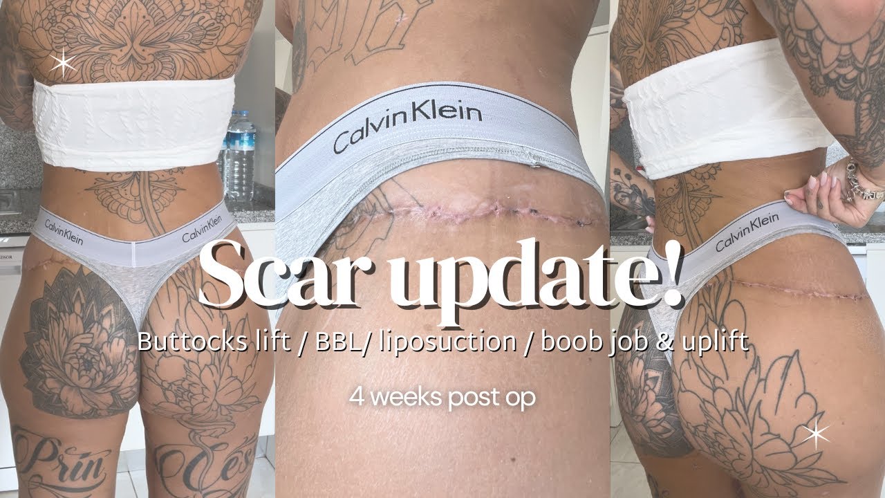 4 week scar update: Buttocks lift / BBL/ liposuction / boob job & uplift 