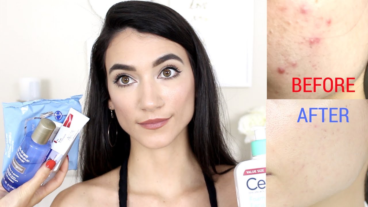 How I Cleared My Acne | My Drugstore Skincare Routine 2017 - YouTube