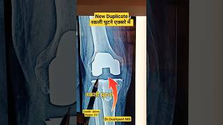 बिलकुल नया घुटना | Duplicate Knee | #totalkneereplacementsurgery#kneepain #kneereplacementoperation