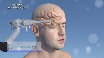 3D Medical animation - Minimally Invasive Neurosurgery
