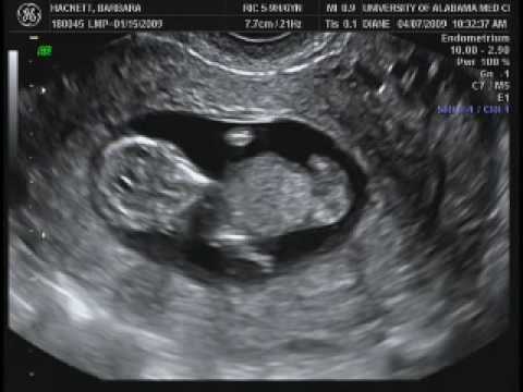 Baby Perry ultrasound at 12 Weeks - YouTube