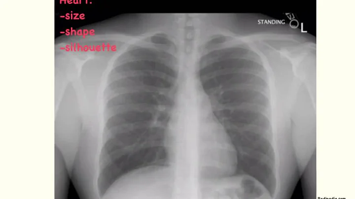 How to read a chest xray, the basics