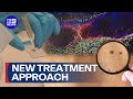Potential new approach for melanoma treatment discovered | 9 News Australia