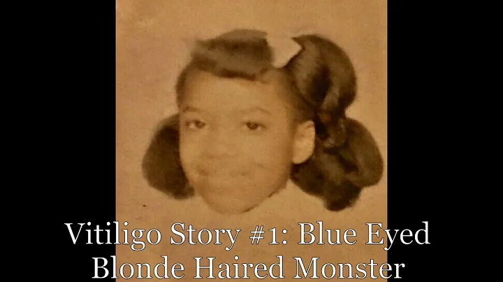 Vitiligo Story #1: Blue Eyed Blonde Haired Monster
