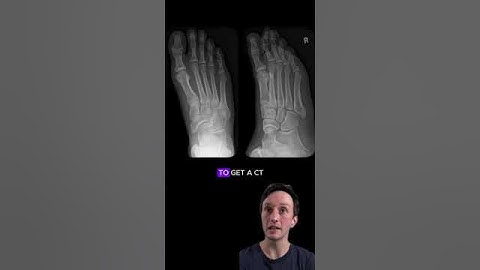 Lisfranc-letsel op röntgenfoto en CT-scan #radiologie #medischstudent #röntgenoloog #orthopedie
