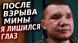 Сапер из Бахмута. Лишился глаз после взрыва мины