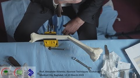 WorkShop 5 Ilizarov Baghdad, March 2023, Prof. Alexander Kirienko, Angular deformity Tibia shaft