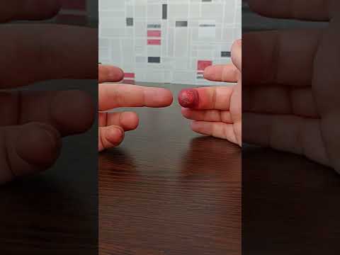 Как избавиться от укуса красноухой черепахи. Последствия укуса