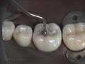 Class I Amalgam Preparation Restoration Operative Dentistry 