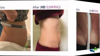 تنحيف إتش دي عالي الدِقَّة قبل وبعد  Before and After HD Slimming for fat loss