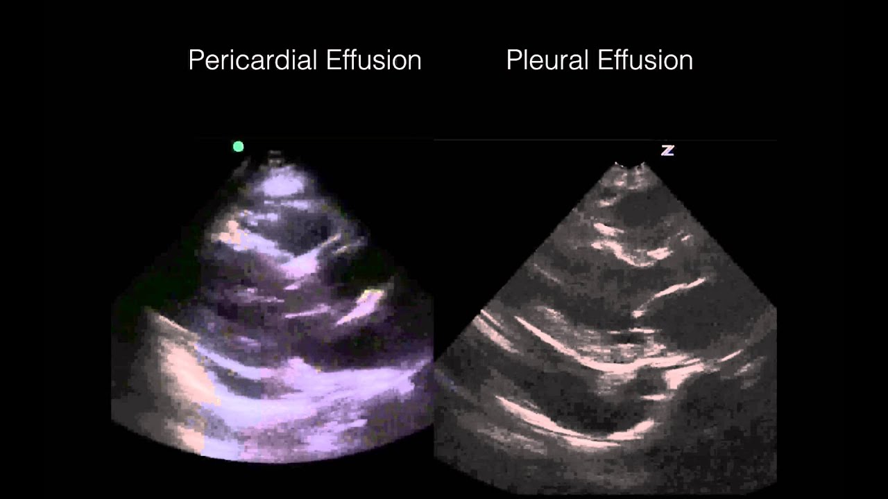 Cardiac Ultrasound Pericardial Vs Pleural Effusion YouTube cardiac-ultrasound-pericardial-vs-pleural-effusion-youtube