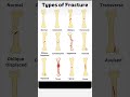 types of bone fracture #medical #medicaleducation