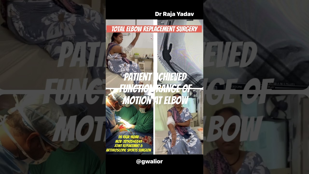 Total elbow replacement surgery 