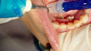 جير الأسنان واضراره | إزالة جير الأسنان removal dental tartar plaque