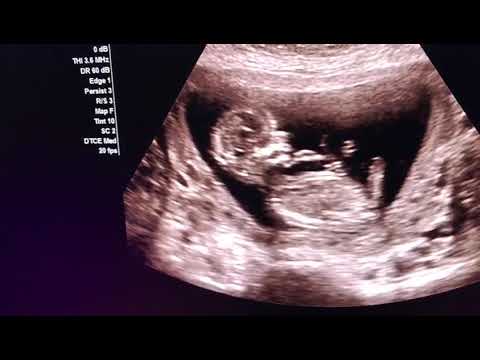 Ultrasound for pregnancy /13 weeks baby dancing in womb 💃  /shorts/Dr Shikha Agarwal