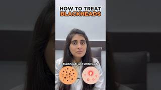 How to get rid of Blackhead | How to remove blackhead from face | Blackhead dermatologist