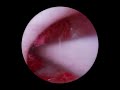 S02E08 - Ear Wax Cleaning of An Ear With Blockage &amp; Other Diseases. Reddish EarWax Removal