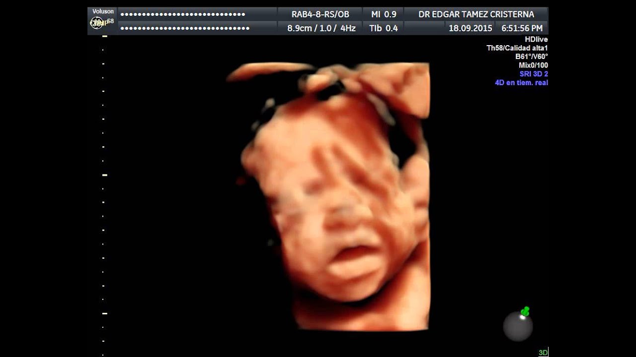 Ultrasonido 4D HD Live embarazo de 26 semanas YouTube Ultrasonido 4D HD Live embarazo de 26 semanas YouTube