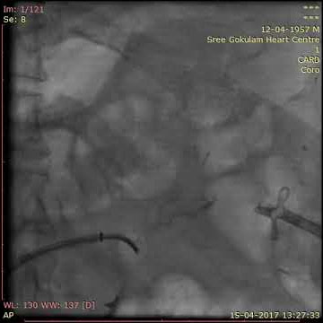 BRTO - Balloon-occluded retrograde transvenous obliteration