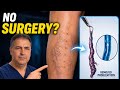 Microphlebectomy — Pin-Hole Surgery (And Why It’s Not What You Think)