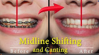 Maxillary Midline Shifting and Canting - Orthodontic Therapy!