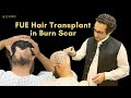Transform Burn Scars into Hair-Filled Canvas: The Magic of FUE Hair Transplant #burnscar #ad #fue