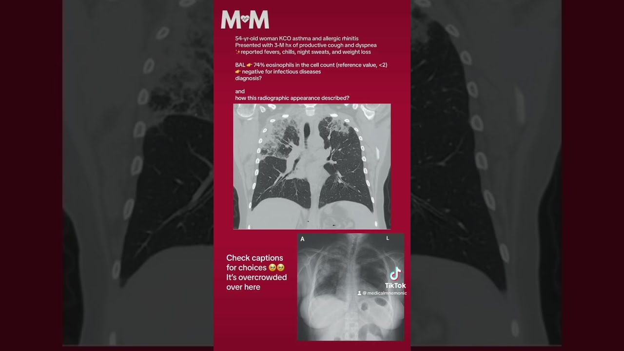 Chronic Eosinophlic Pneumonia Shorts Medicalquizzes Medicaleducation