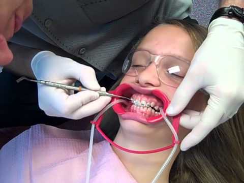 How are braces put on? Midland Orthodontist Dr. Dale Davis explains!
